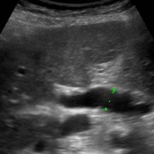 Sỏi đường mật