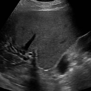 Sỏi đường mật