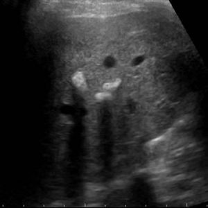 Sỏi đường mật