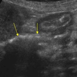 Khí đường mật