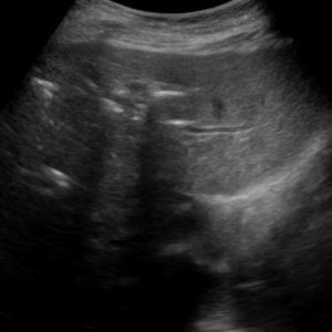 Khí đường mật