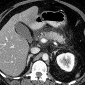 Rò tĩnh mạch cửa