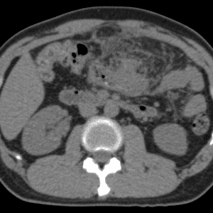 Thủng đại tràng ngang do dị vật