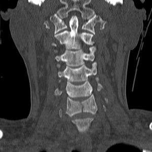 Chấn thương cột sống