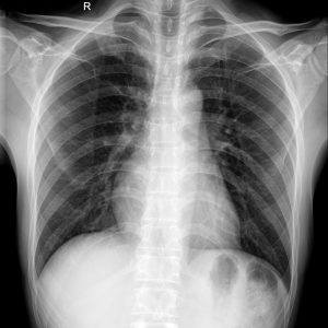 Gãy xương sườn