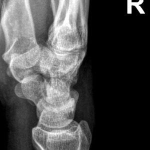 Chấn thương cổ tay