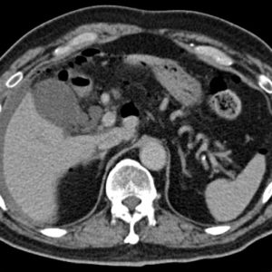 Thủng hành tá tràng