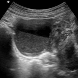 Nang buồng trứng