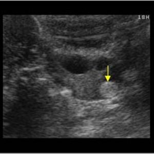 Nang buồng trứng