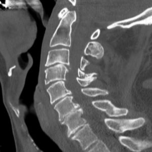 Chấn thương cột sống