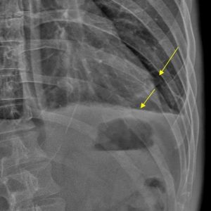 Gãy xương sườn