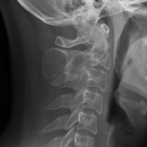 Nang xương phình mạch