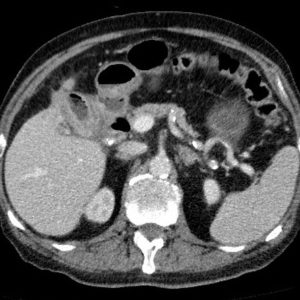 Tắc ruột sỏi mật