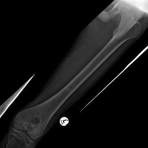 U nguyên bào sụn