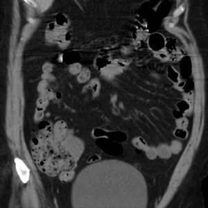 U nhầy ruột thừa
