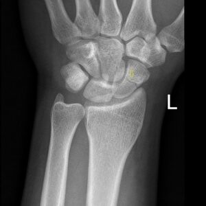 Chấn thương cổ tay