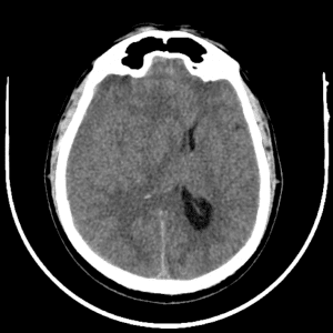 Tụ máu dưới màng cứng