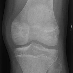 U nguyên bào sụn