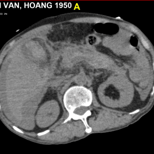Chảy máu túi mật