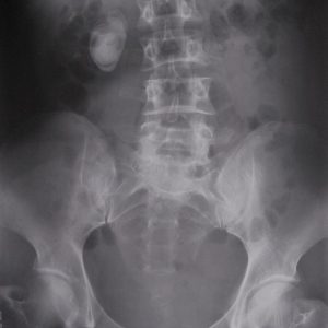 Sỏi niệu quản