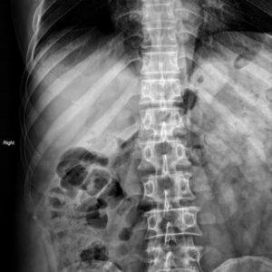 Sỏi đường mật