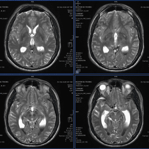 Chảy máu não thất