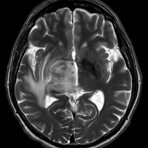 Toxoplasmosis