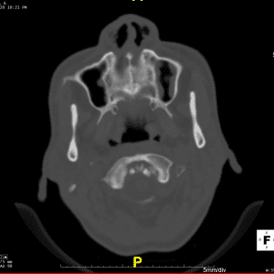 Vôi hoa dây chằng cánh