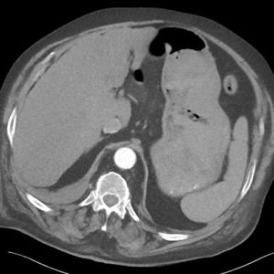 Chảy máu dạ dày