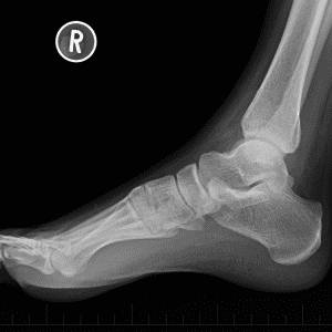 Gãy xương cẳng chân