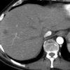 Lymphoma gan - Ảnh 2