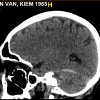 Tụ máu DMC - Hình ảnh 6