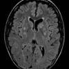 Toxoplasmosis - Hình ảnh 2