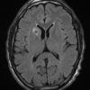 Toxoplasmosis - Hình ảnh 2