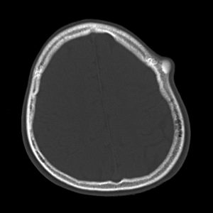 U tế bào tạo xương