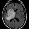 Toxoplasmosis - Hình ảnh 2