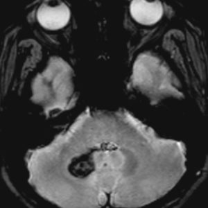 Mạch máu nhiễm bột
