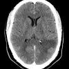 Toxoplasmosis - Ảnh 2