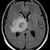 Toxoplasmosis - Hình ảnh 2