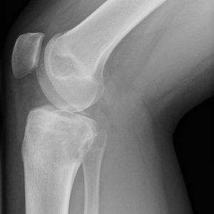 U nguyên bào sụn