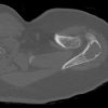 Sarcoma sụn - Ảnh 2