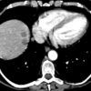 Lymphoma gan - Hình ảnh 2