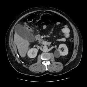 Viêm túi mật cấp