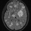 Toxoplasmosis - Hình ảnh 2