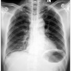 Khí tự do ổ bụng