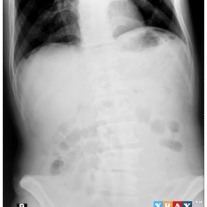 Thủng tạng rỗng