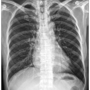 Gãy xương sườn