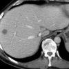 Lymphoma gan - Ảnh 3