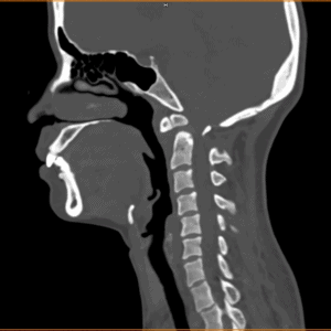 Cốt hóa mỏm nha