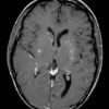 Toxoplasmosis - Hình ảnh 3